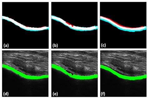 ultrasound validity in the measurement of knee cartilage thickness|Knee.